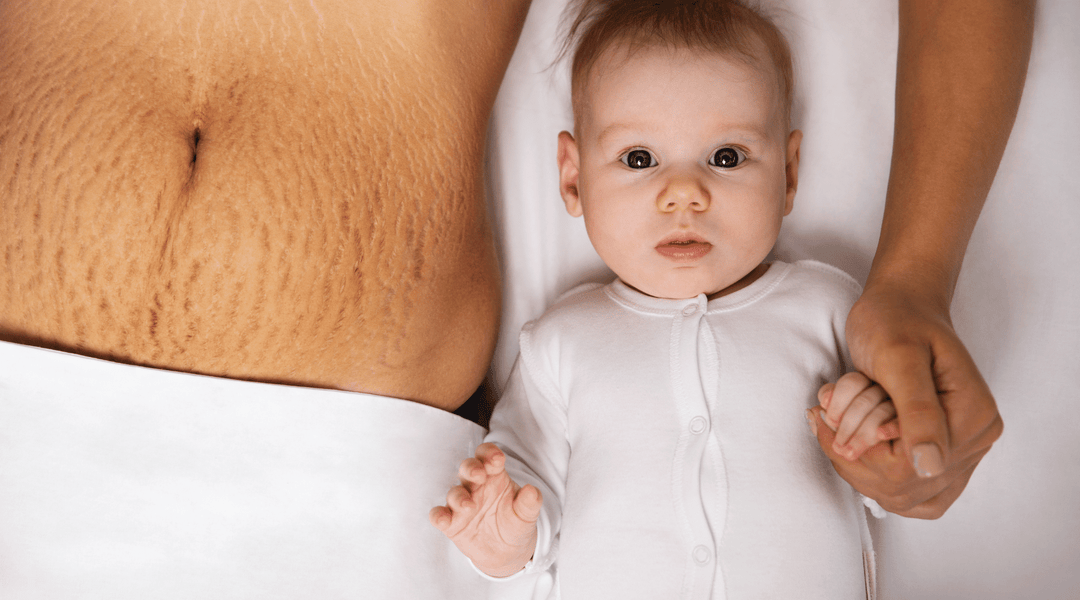 Post partum mother with newborn baby and deep, red stretch marks on the stomach and abdomen from pregnancy.