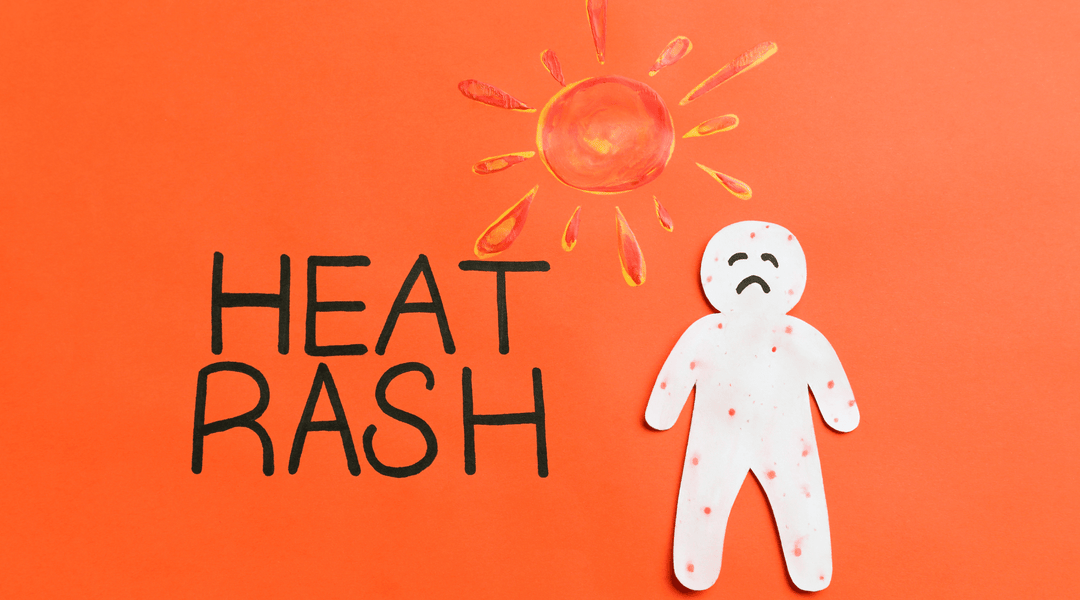 Stop & Prevent Heat Rash With a Plant-Based, Natural Treatment